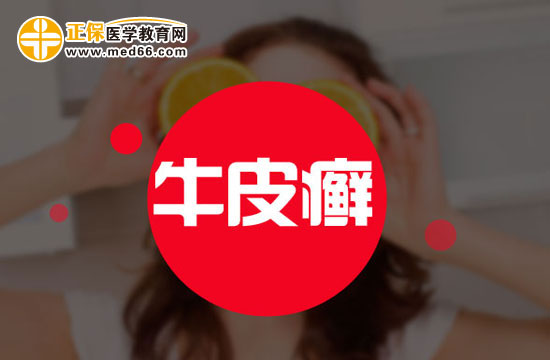 普通不太嚴(yán)重的牛皮癬能治好嗎？